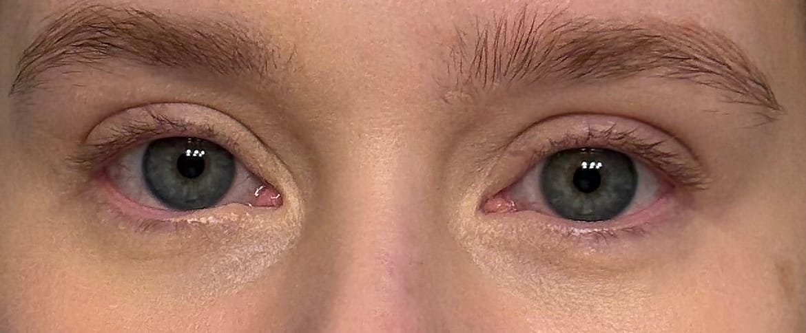 How to Find Your Undereye Bags and Actually Do Something About Them